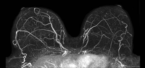 Breast-mr-2