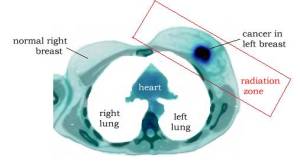 breast_pet_CT_left_sah_radiation