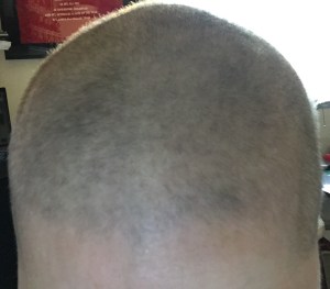 82 days since last chemo.